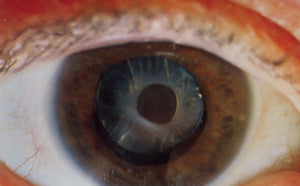 Simple, but Scary: Richard's Looming Cataract Surgery